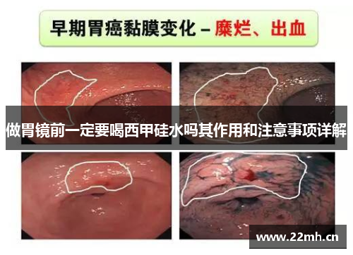 做胃镜前一定要喝西甲硅水吗其作用和注意事项详解